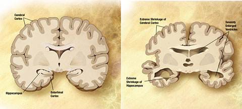 Why some people with brain markers of Alzheimer’s have no dementia