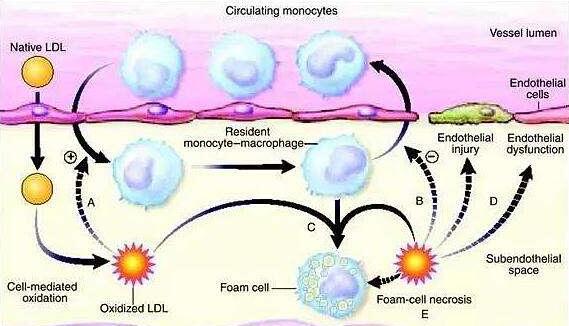 Gene discovery reveals new targets for treating atherosclerosis, inflammatory diseases