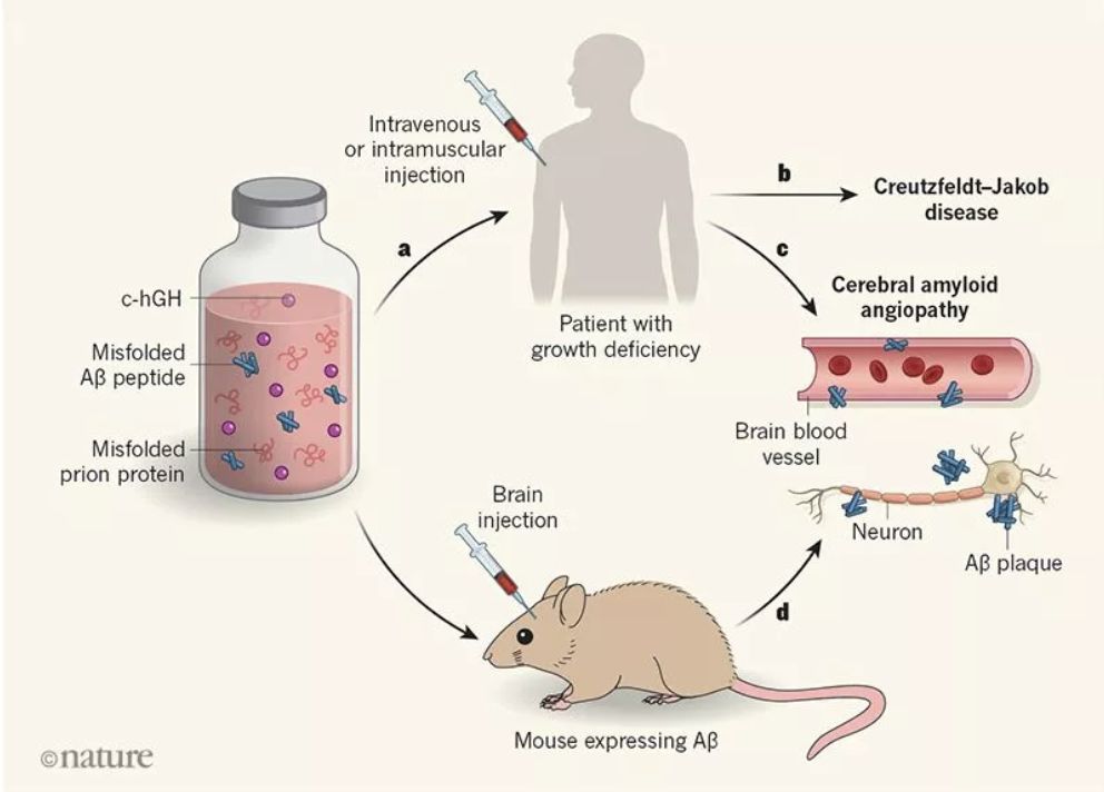 Transmission of amyloid-β protein pathology from cadaveric pituitary growth hormone