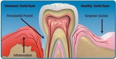 Immune-regulating drug improves gum disease in mice