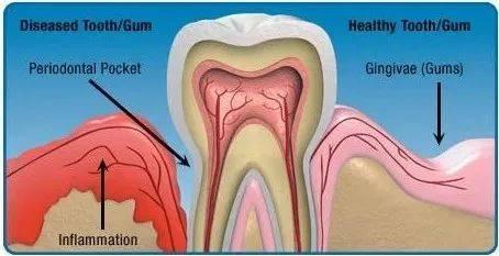 Immune-regulating drug improves gum disease in mice