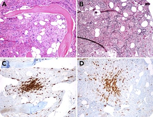 Hereditary alpha tryptasemia is a valid genetic biomarker for severe mediator-related symptoms in mastocytosis