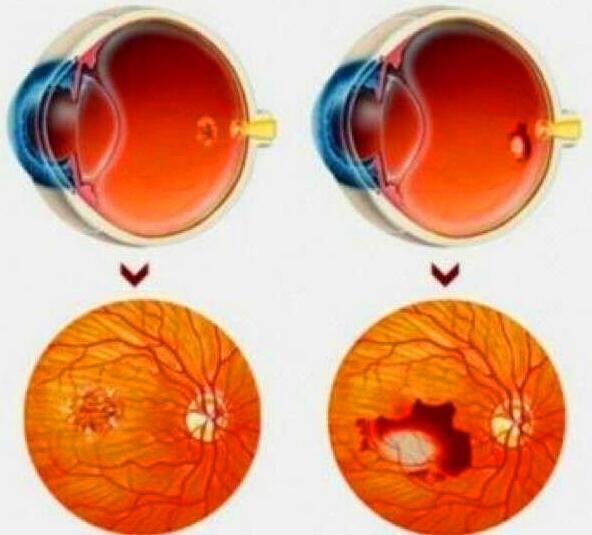 Vitamin D Levels May Affect Macular Degeneration Risk