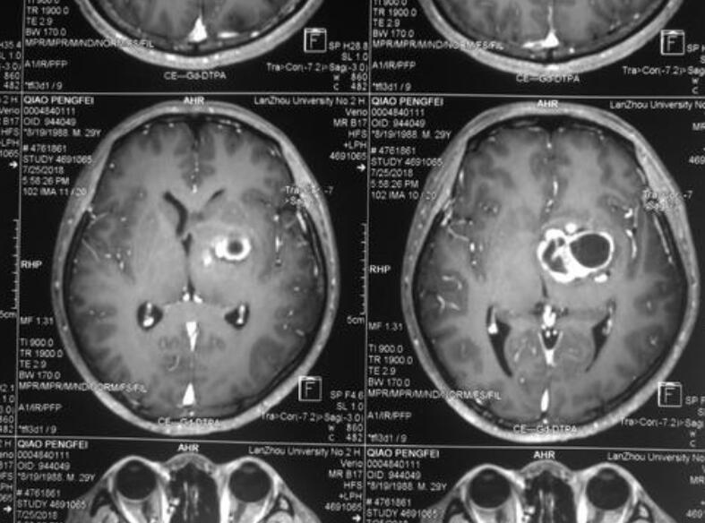 Progress in drug treatment of refractory prolactinoma