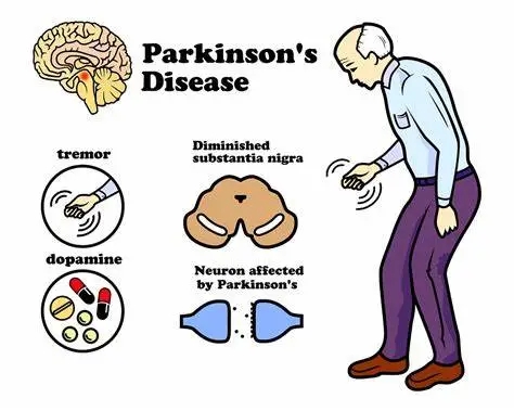11 possible causes of Parkinson&acutes disease