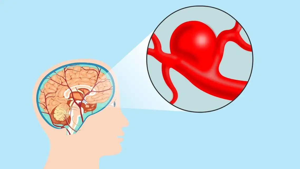 Research status of pathogenic genes related to intracranial aneurysms