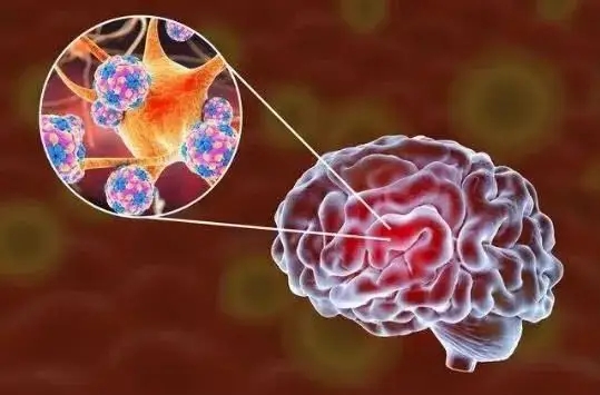 About  1/5 patients with acute covid-19 may develop daily chronic headache