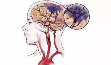 Longitudinal Study Reveals Long-Term Proinflammatory Proteomic Signature After Ischemic Stroke Across Subtypes