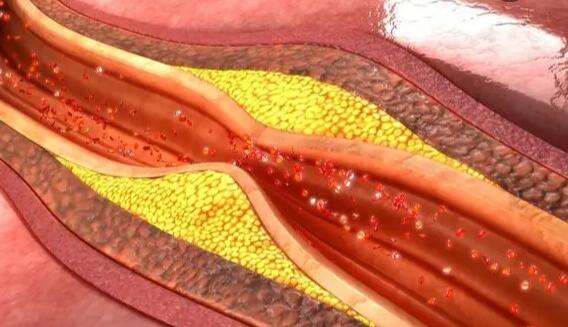 Targeted Plasma Proteomics to Predict the Development of Carotid Plaques