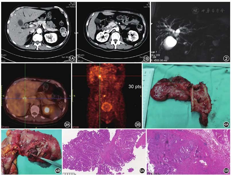 Hereditary cancer variants and homologous recombination deficiency in biliary tract cancer